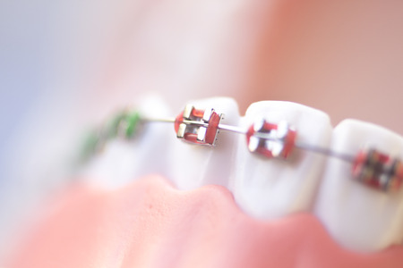 Cosmetic dentistry orthodontics dental metal wire teeth brackets teaching student model.の写真素材
