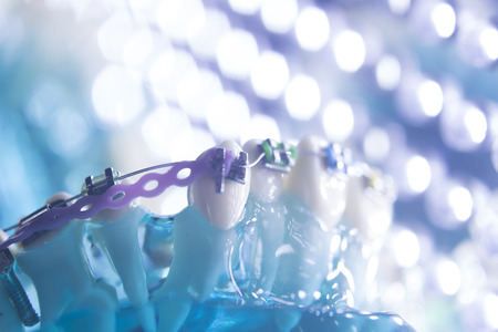 Dental teeth retainers metal aligners brackets to straighten teeth in orthodontic dentistry...