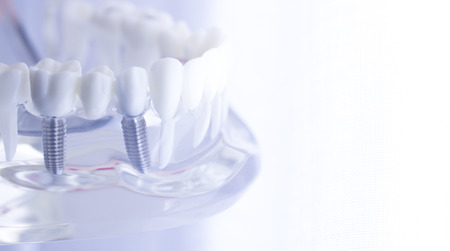 Dental teeth mouth dentists teaching model with teeth, gums, molars and wisdom tooth.