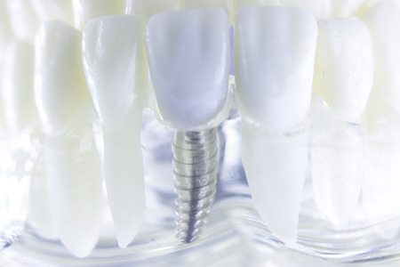 Dental titanium aesthetic orthodontic tooth implant in dentists mouth teeth model closeup isolated.の写真素材