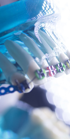 Dental teeth retainers metal aligners brackets to straighten teeth in orthodontic dentistry...