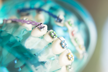 Dental teeth retainers metal aligners brackets to straighten teeth in orthodontic dentistry...