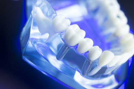 Dental teeth orthodontic dentistry teachng model with gums, tooth enamel, plaque, roots and metal implants.の写真素材
