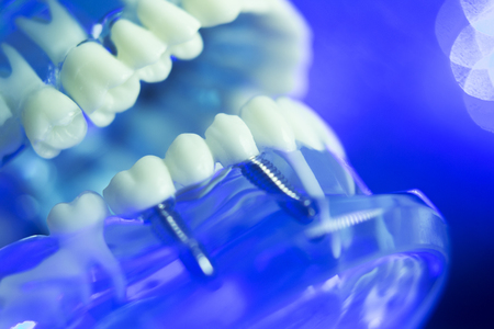 Dental teeth orthodontic dentistry teachng model with gums, tooth enamel, plaque, roots and metal...