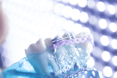 Dental teeth retainers metal aligners brackets to straighten teeth in orthodontic dentistry...