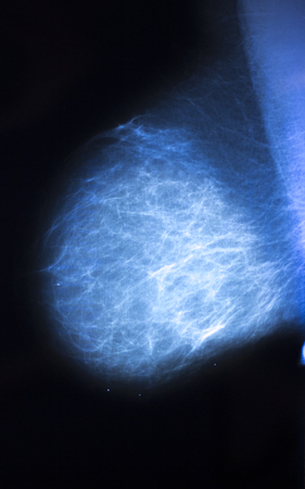 Medical hospital mammography x-ray breast cancer mammogram scan.の写真素材