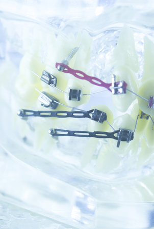 Orthodontics dentists teaching model dental teeth plastic and metal brackets aligners to straighten...