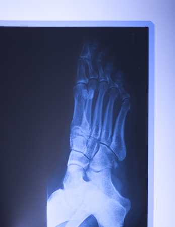 Medical hospital x-ray feet traumatology scan.