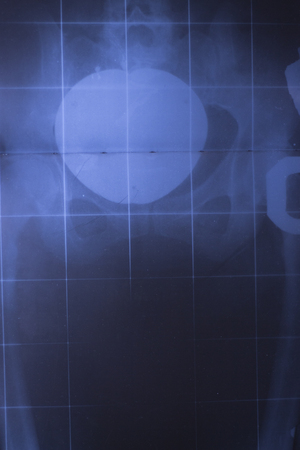 Medical hospital x-ray lowe back pain spine and hips traumatology scan also showing stomach and...