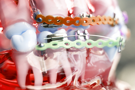 Dental metal braces teeth retainer aligners teaching orthodontics model.の写真素材