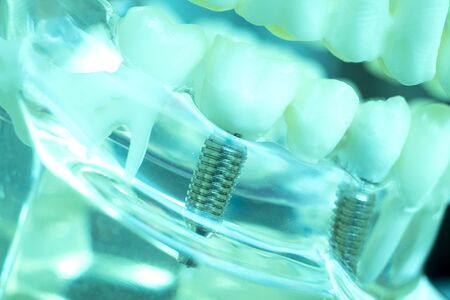 Dentist dental teeth teaching model showing titanium metal tooth implant screw.
