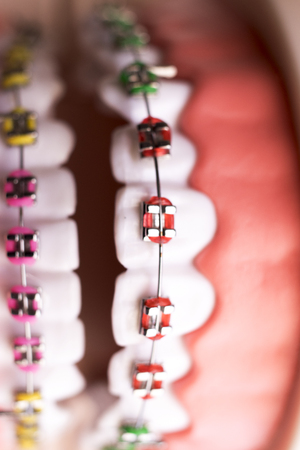 Dental metal braces teeth retainer aligners teaching orthodontics model.