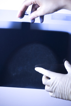 Medical hospital mammography x-ray breast cancer mammogram scan.の写真素材