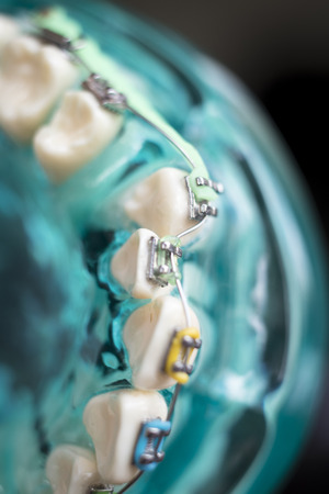 Dental metal braces teeth retainer aligners teaching orthodontics model.の写真素材