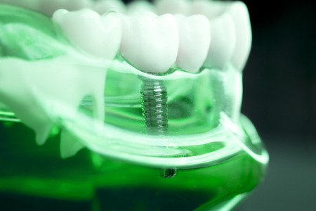 Dentist dental teeth teaching model showing titanium metal tooth implant screw.の写真素材