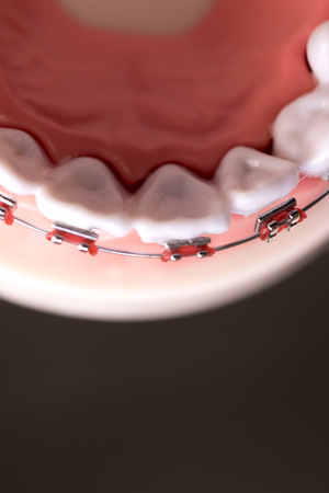 Dental metal braces teeth retainer aligners teaching orthodontics model.の写真素材