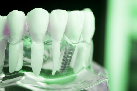 Dentist dental teeth teaching model showing titanium metal tooth implant screw.の写真素材