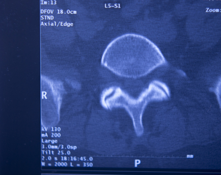 Medical hospital x-ray hips spine pelvis MRI traumatology scan.の写真素材
