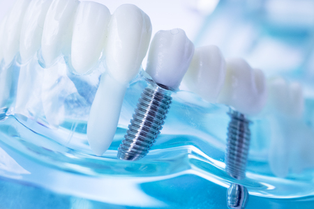 Dentist dental teeth teaching model showing titanium metal tooth implant screw.の写真素材