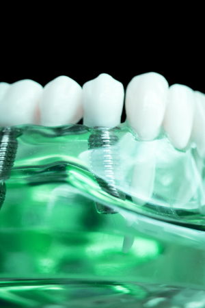 Dentist dental teeth teaching model showing titanium metal tooth implant screw.の写真素材