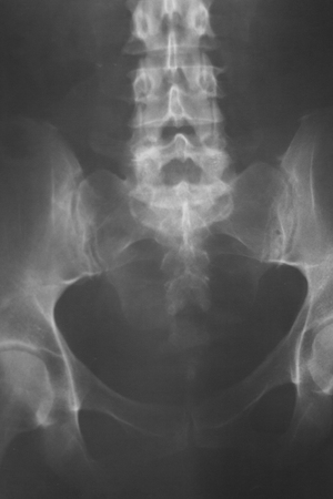 Medical hospital x-ray lowe back pain spine and hips traumatology scan.