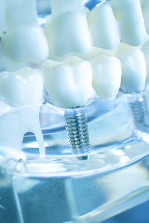 Dentist dental teeth teaching model showing titanium metal tooth implant screw.