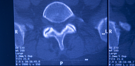 Medical hospital x-ray hips spine pelvis MRI traumatology scan.の写真素材