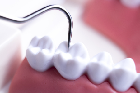 Dentist cleaning teeth with titanium metal tooth pick instrument to remove plaque and decay.