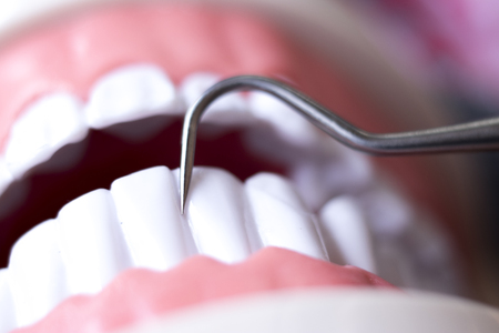 Dentist cleaning teeth with titanium metal tooth pick instrument to remove plaque and decay.の写真素材