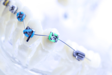 Dental metal braces teeth retainer aligners teaching orthodontics model.