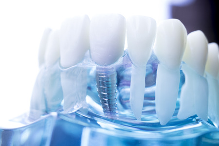 Dentist dental teeth teaching model showing titanium metal tooth implant screw.の写真素材