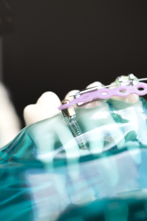 Dental metal braces teeth retainer aligners teaching orthodontics model.の写真素材