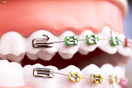 Dental metal braces teeth retainer aligners teaching orthodontics model.の写真素材