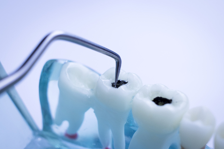 Dentist cleaning teeth with titanium metal tooth pick instrument to remove plaque and decay.の写真素材