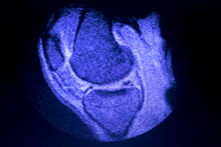 Magnetic resonance imaging MRI knee posterior horn medial meniscus tear scantest results.の写真素材