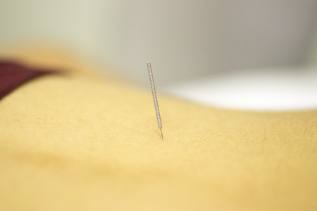 Physiotherapy clinic Intratissue Percutaneous Electrolysis EPI dry needling physiotherapist patient...