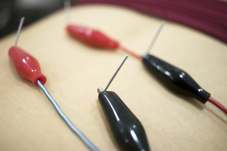 Physiotherapy clinic Intratissue Percutaneous Electrolysis EPI dry needling physiotherapist patient injury.の写真素材