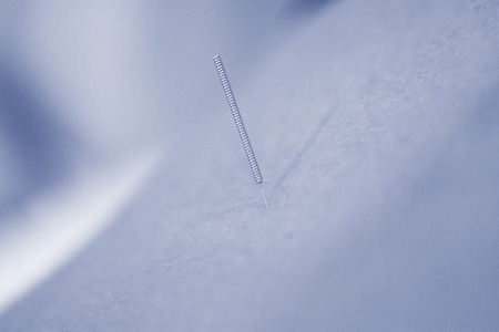 Physiotherapy clinic Intratissue Percutaneous Electrolysis EPI dry needling physiotherapist patient needle.の写真素材