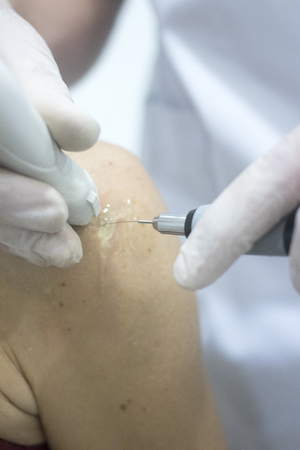 Physiotherapy clinic Intratissue Percutaneous Electrolysis EPI dry needling physiotherapist patient...