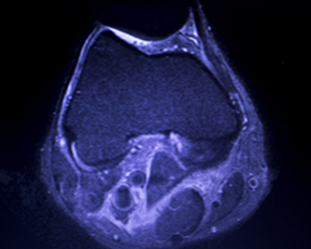 Magnetic resonance imaging MRI knee posterior horn medial meniscus tear scantest results.の写真素材