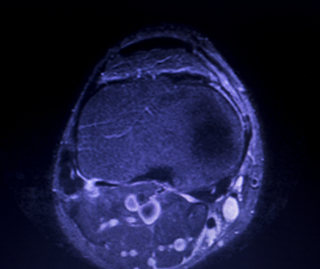 Magnetic resonance imaging MRI knee posterior horn medial meniscus tear scantest results.の写真素材