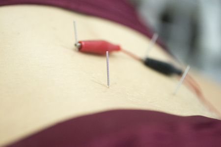 Physiotherapy clinic Intratissue Percutaneous Electrolysis EPI dry needling physiotherapist patient injury.の写真素材