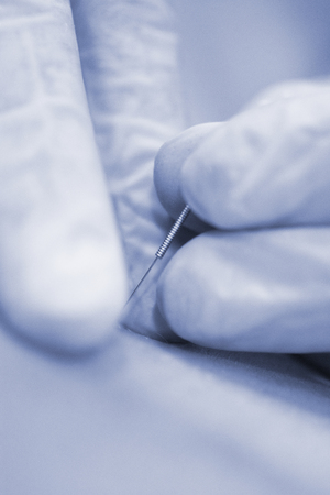 Physiotherapy clinic Intratissue Percutaneous Electrolysis EPI dry needling physiotherapist patient...