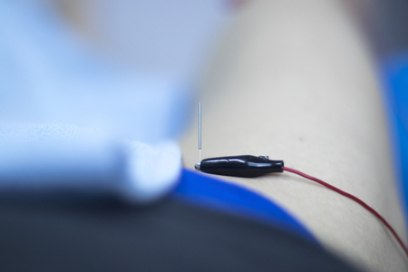EPI Intratissue Percutaneous Electrolysis dry needling ultrasound ecography scan  physiotherapy...