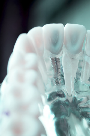 Dentist dental teeth teaching model showing titanium metal tooth implant screw.の写真素材
