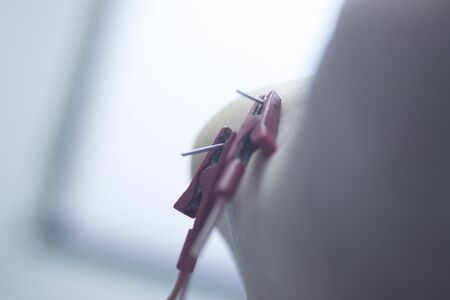 EPI Intratissue Percutaneous Electrolysis dry needling physical therapy medical treatment.