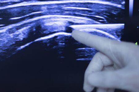 EPI Intratissue Percutaneous Electrolysis dry needling ultrasound ecography scan  physiotherapy...