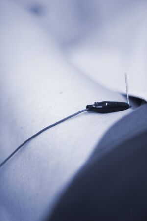 EPI Intratissue Percutaneous Electrolysis dry needling ultrasound ecography scan  physiotherapy medical treatment.の写真素材