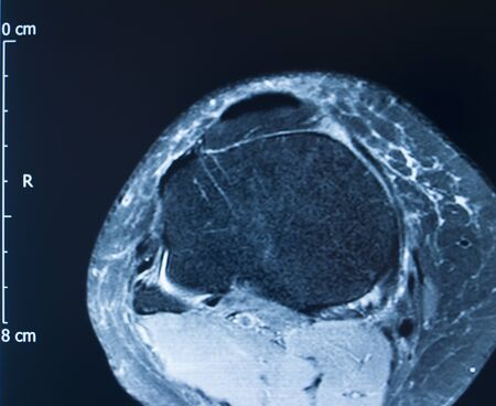 Knee sports injury mri mcl grade 2 tear magnetic resonance imaging orthopedic traumatology scan.の写真素材