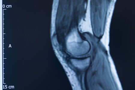 Knee sports injury mri mcl grade 2 tear magnetic resonance imaging orthopedic traumatology scan.の写真素材